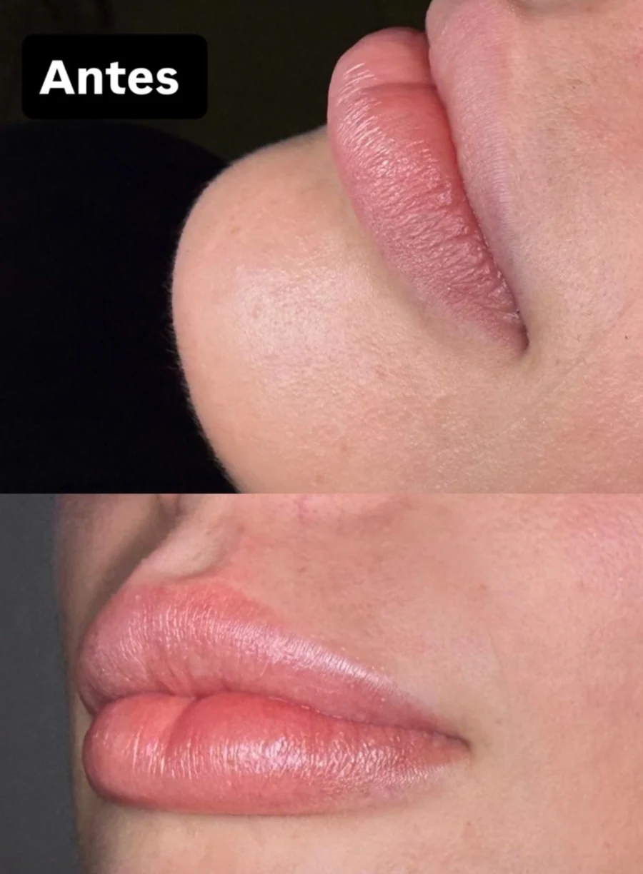 Resultado real de preenchimento labial