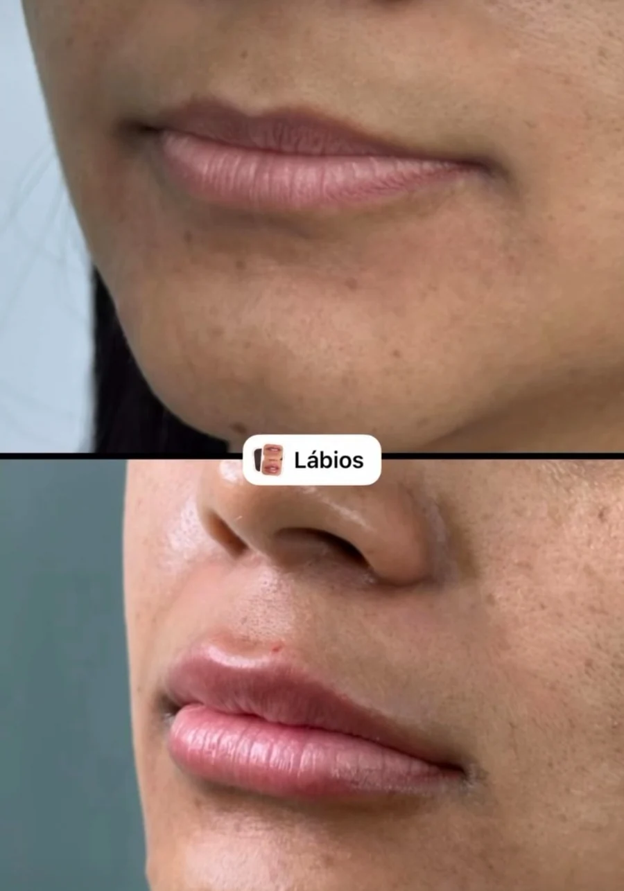Resultado real de preenchimento labial